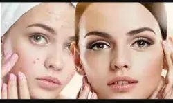 Home Remedies For Pimples Home Remedies For Pimples