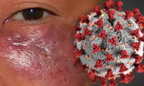 कोरोना से ठीक हो चुके मरीजों में म्यूकोरमाइकोसिस का खतरा, गुजरात के बाद ओडिशा में भी ब्लैक फंगस का मामला मिला कोरोना से ठीक हो चुके मरीजों में म्यूकोरमाइकोसिस का खतरा, गुजरात के बाद ओडिशा में भी ब्लैक फंगस का मामला मिला